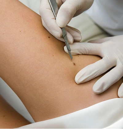 Close-up of a medical professional's gloved hands using a scalpel to perform a precise skin procedure on a patient's leg.