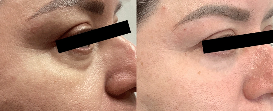 c02laserresurfacing-11-1