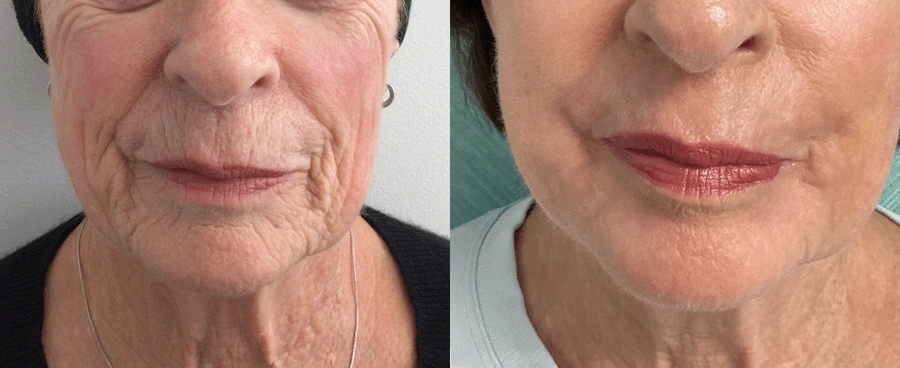 c02laserresurfacing-15-1