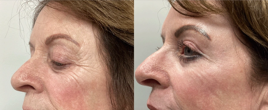 co2laserresurfacing-02-1