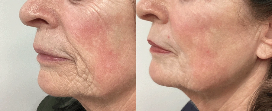 laserskinresurfacing-01-1