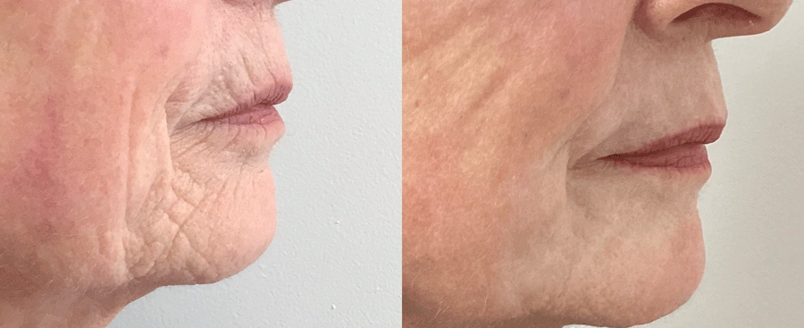 laserskinresurfacing-03-1