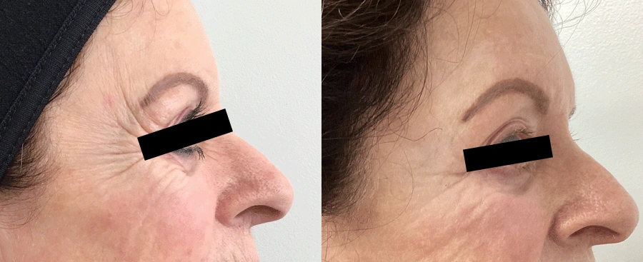 laserskinresurfacing-06-1