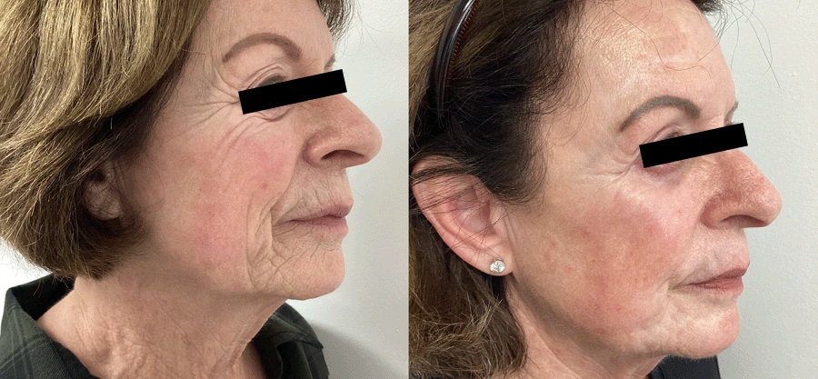 laserskinresurfacing-07-1