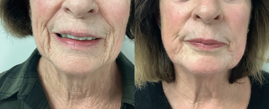 laserskinresurfacing-09-1