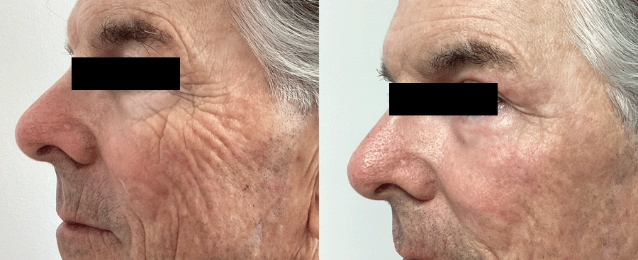 laserskinresurfacing-12-1