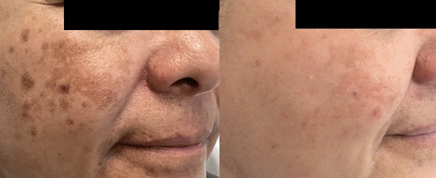 melasma-v2