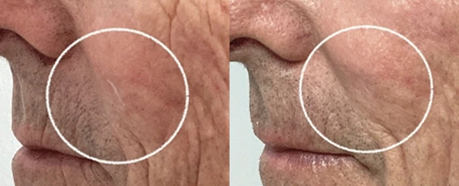 scarrevision-01-1-v2