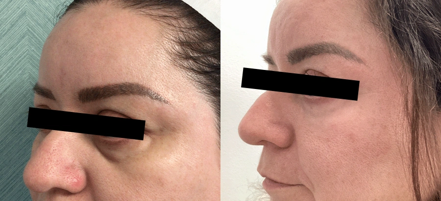 undereyecircles-01-1