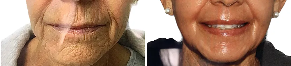 wrinkle_laser_c02 copy