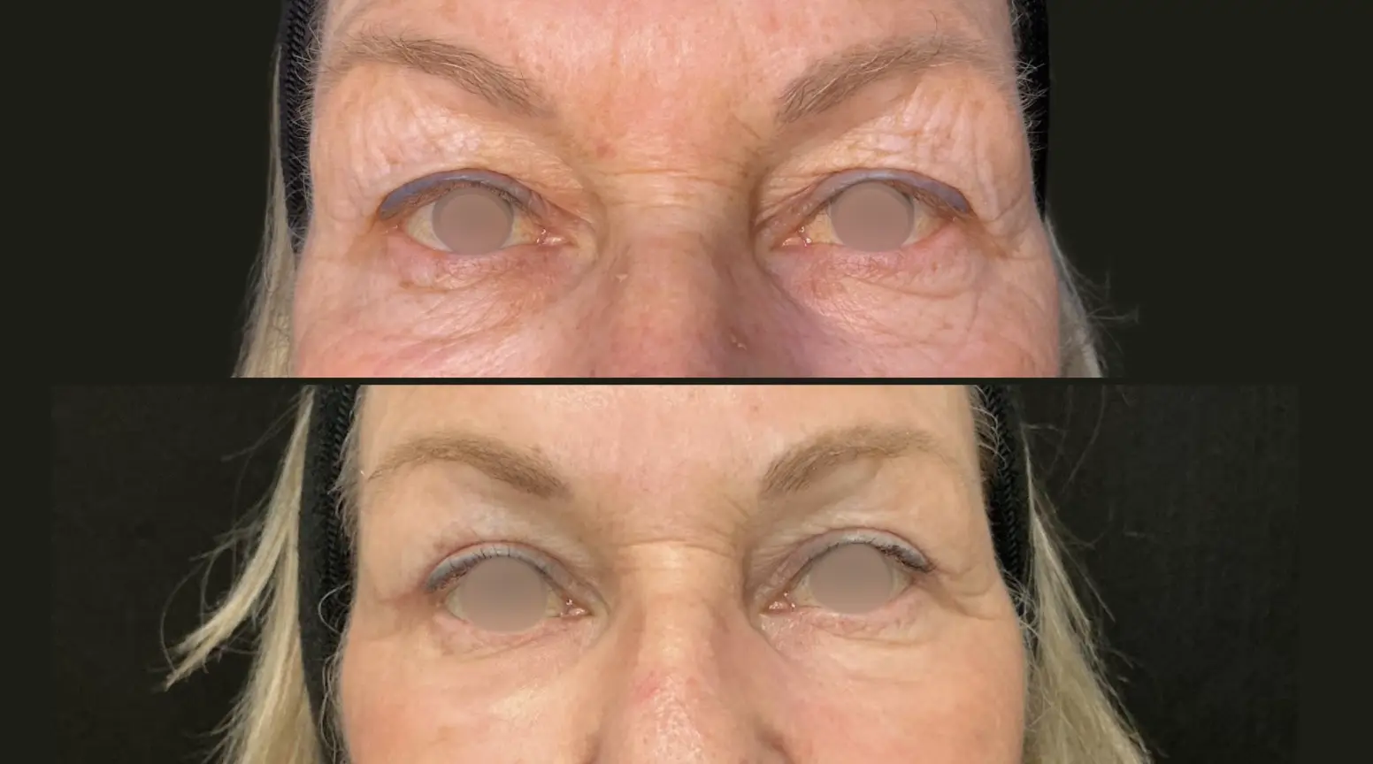 laser bleph before and after
